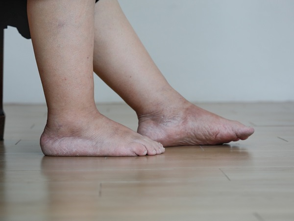 pés inchados retenção de liquido edema