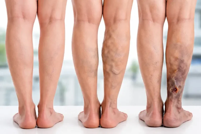 Estágios das varizes venosas Como identificar cada fase