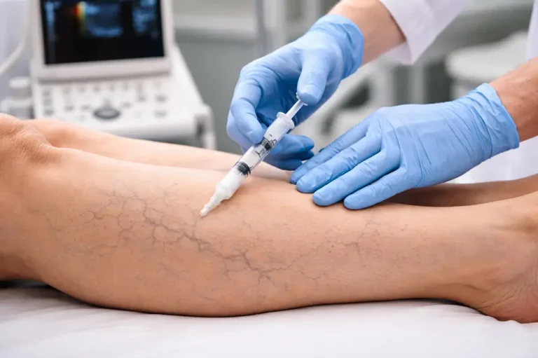 Tratamento de varizes com espuma