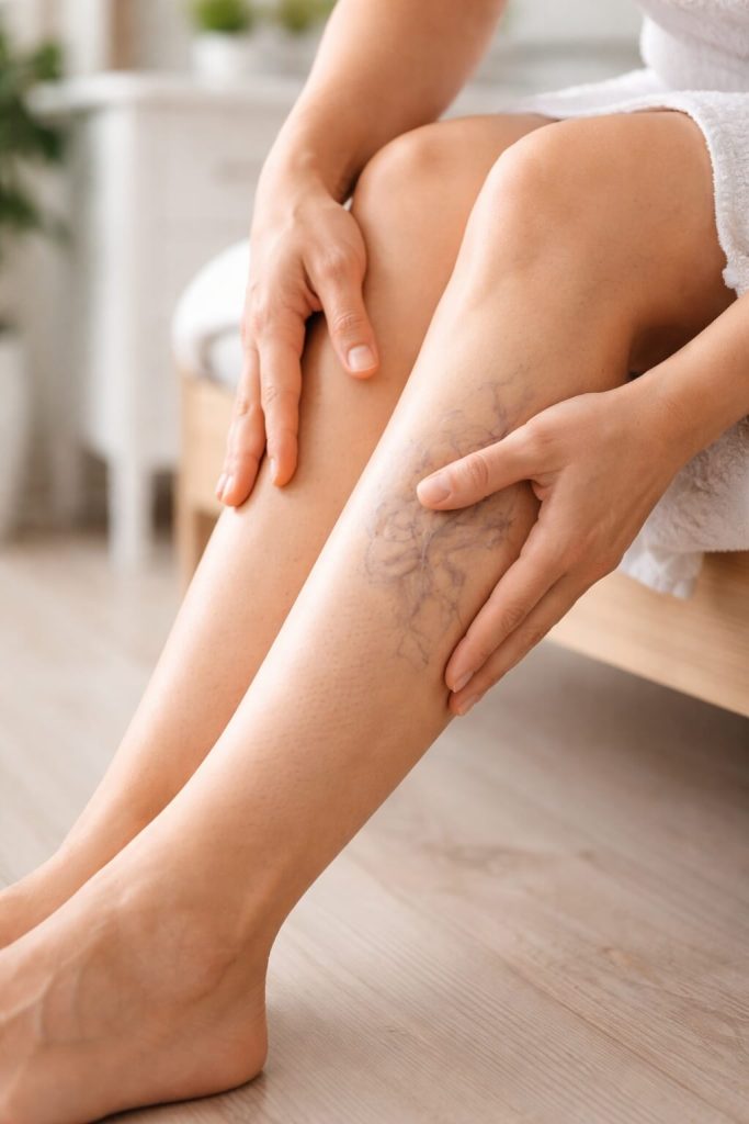 Como saber se tenho varizes?