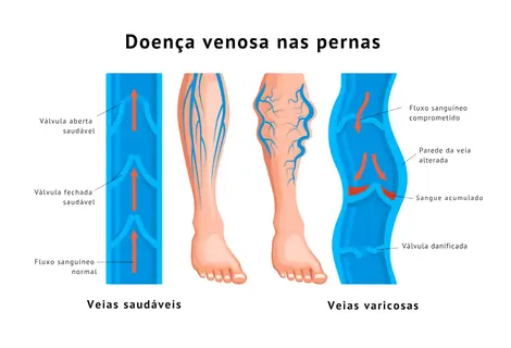 Ilustração de insuficiência venosa com válvulas e varizes nas pernas