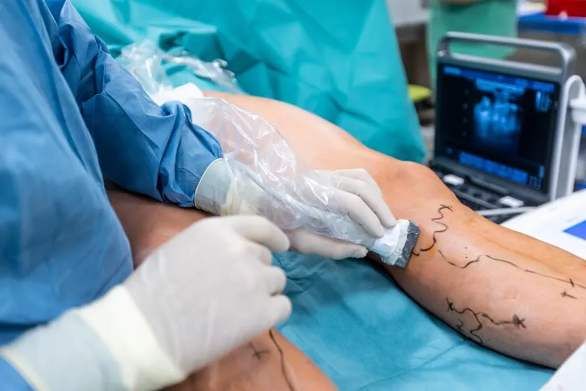 Cirurgia de Varizes